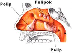 Orrpolip